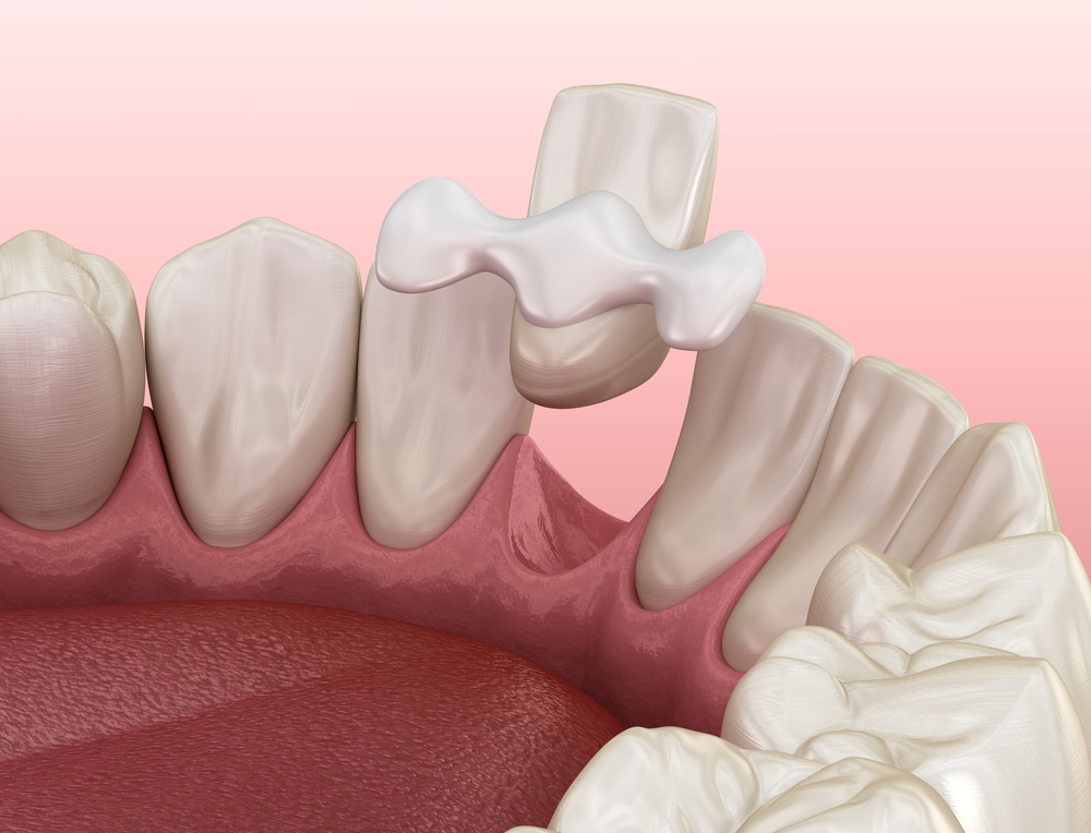 Адгезивные мосты - 1