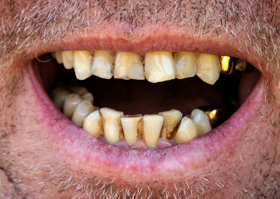 пародонт фото