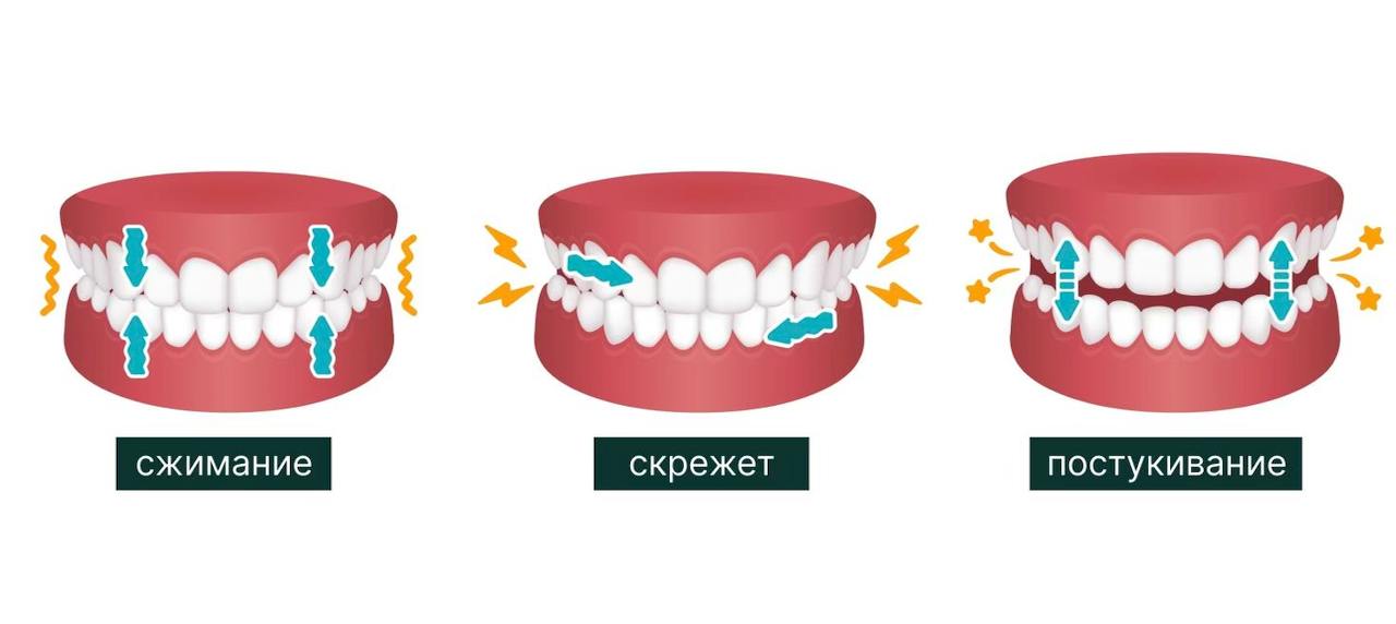 признаки бруксизма