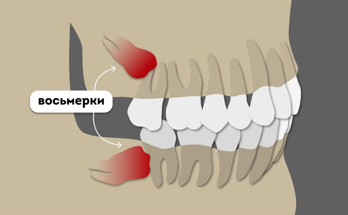 что такое ретинированной восьмерки как выглядят