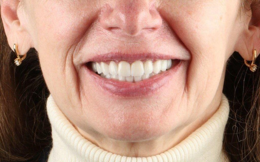 Эстетическая реабилитация керамическими реставрациями - 1