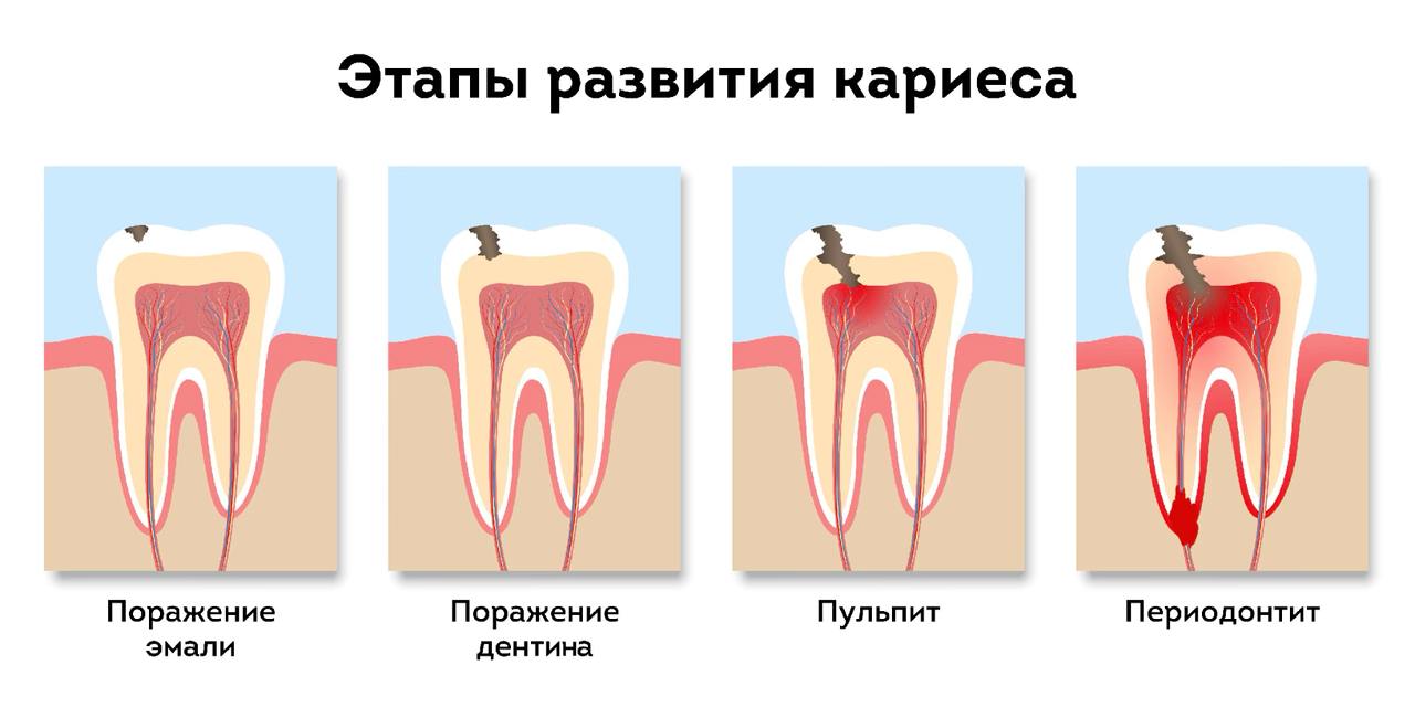 этапы развития кариеса на зубах