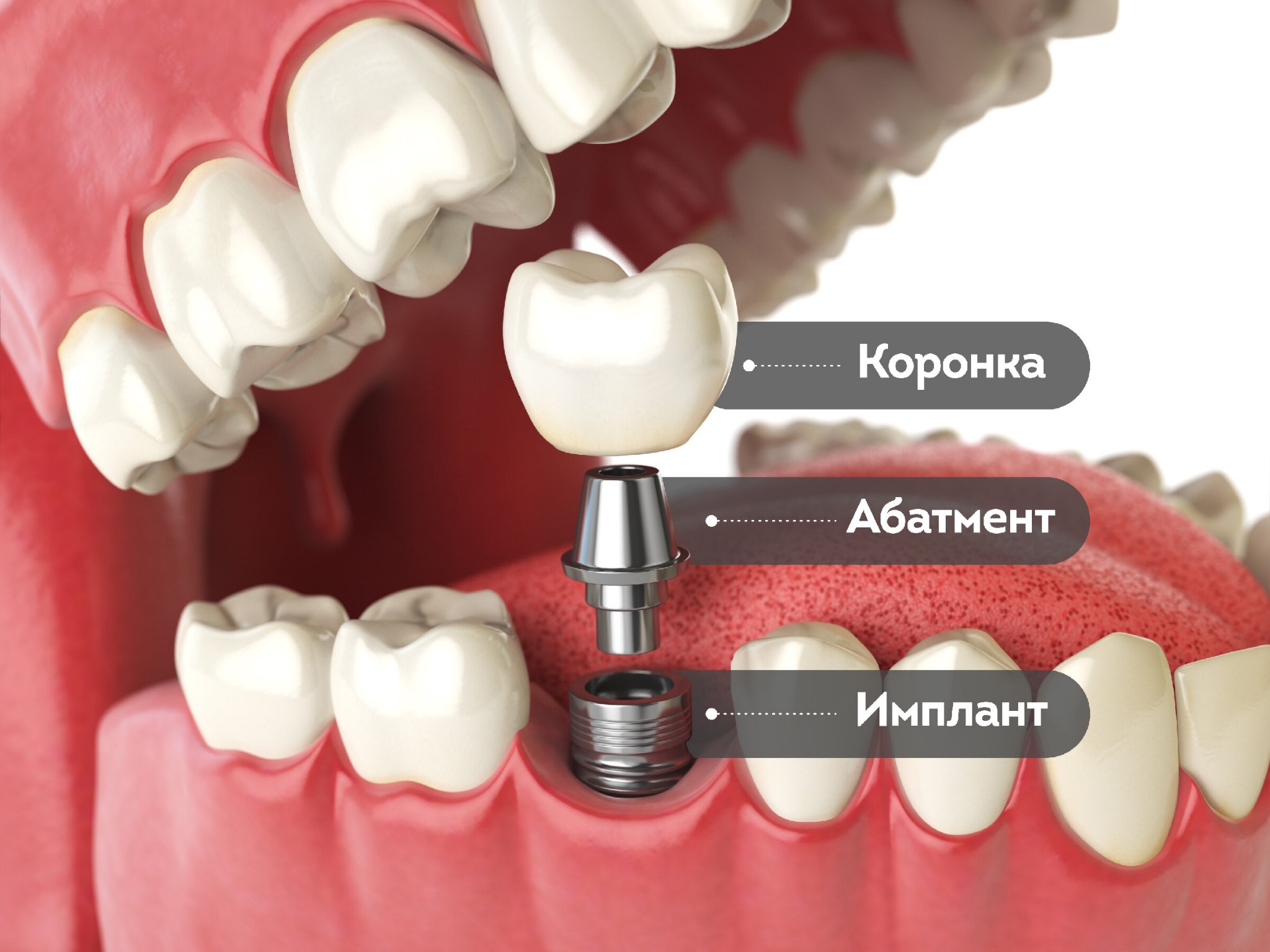 имплантация зубов без обточки