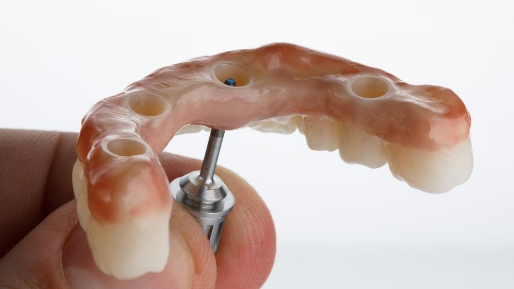 как выглядят протезы все на 4 имплантах