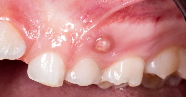 Как выглядит флюс