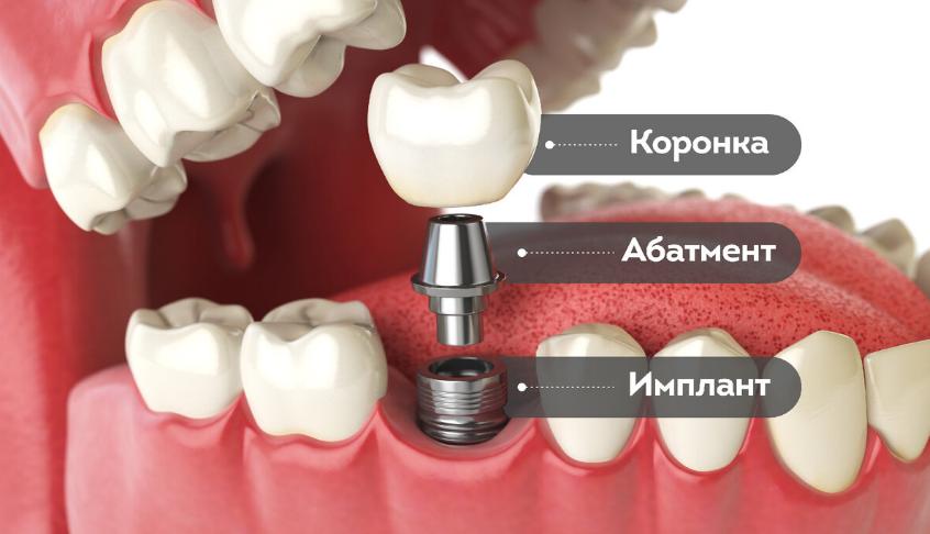 Микропротезирование схема - 1