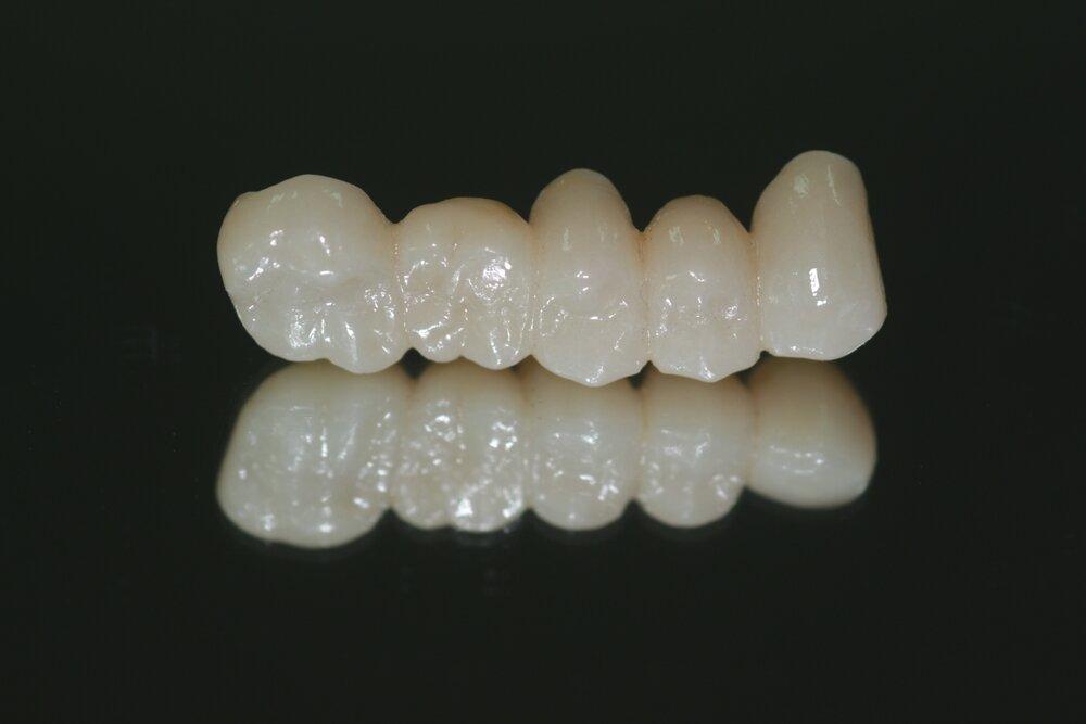 Мостовидный несъемный протез их циркония - 1