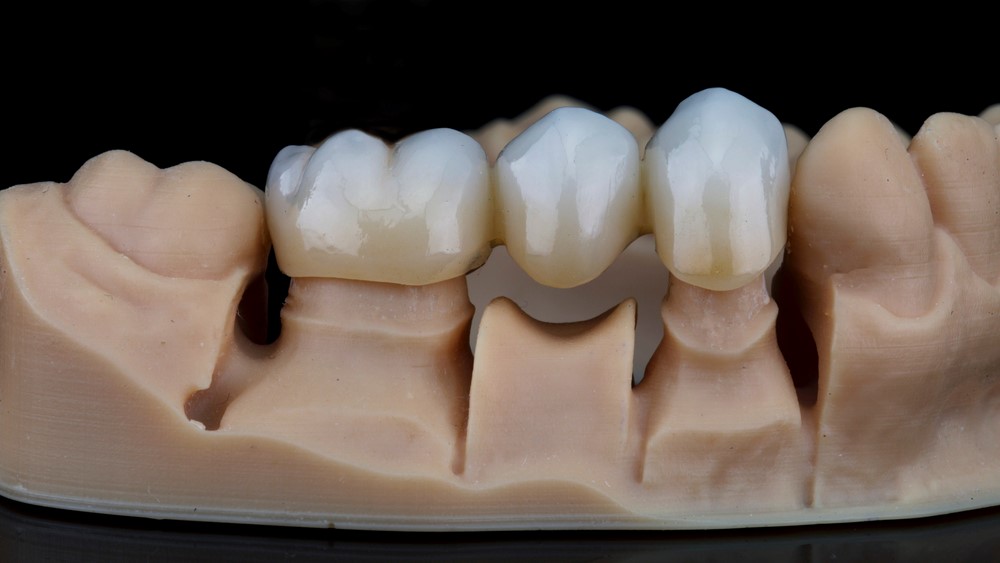 несъемные протезы мосты