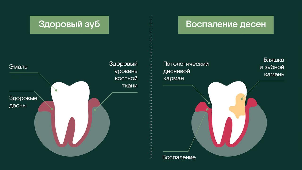 отличие здоровых десен от восполенных