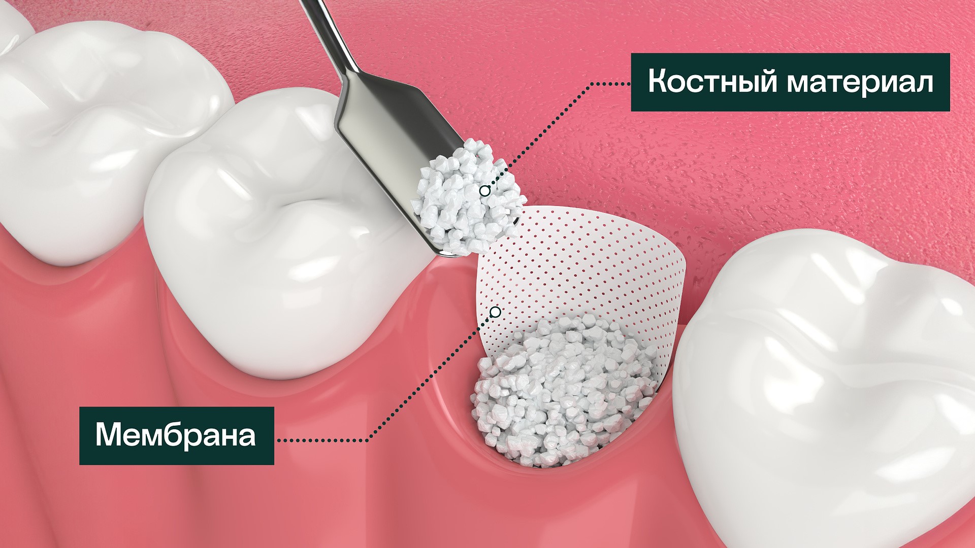 подготовка к имплантации синус лифтинг