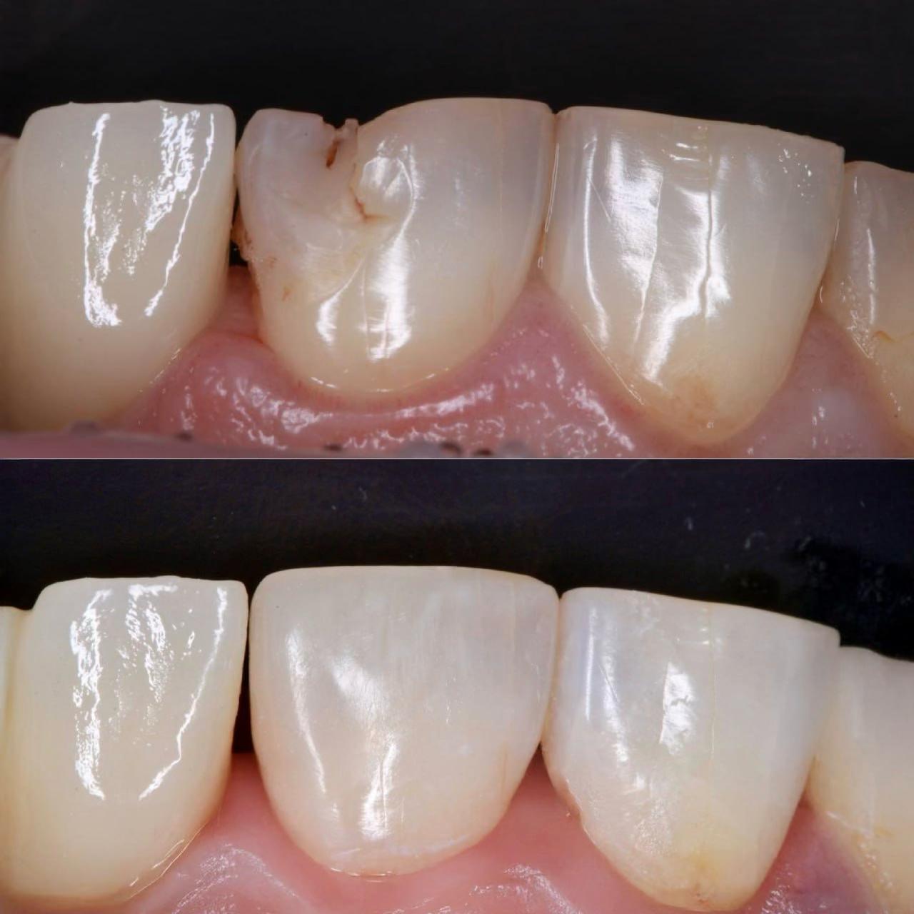 пример лечения кариеса на передних зубах