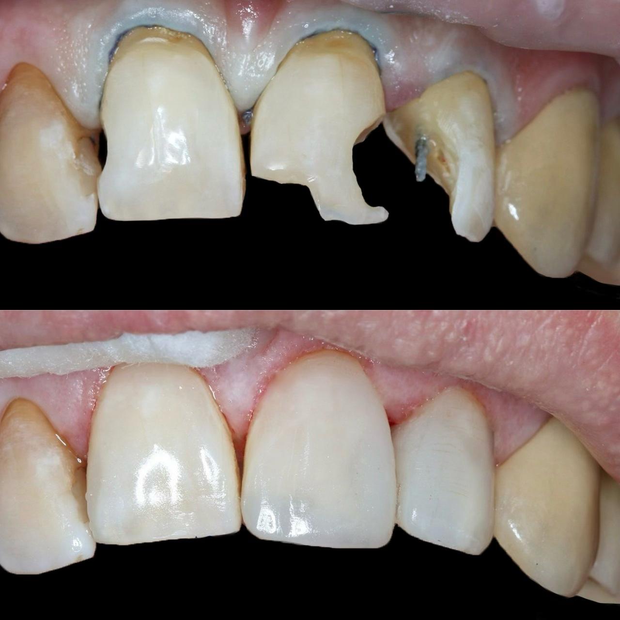 пример лечения кариеса на передних зубах 2