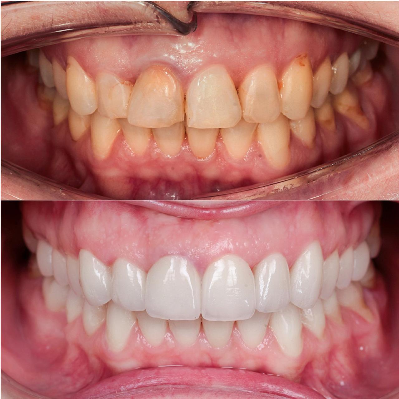 фото-пример лечения зубов под микроскопом 4