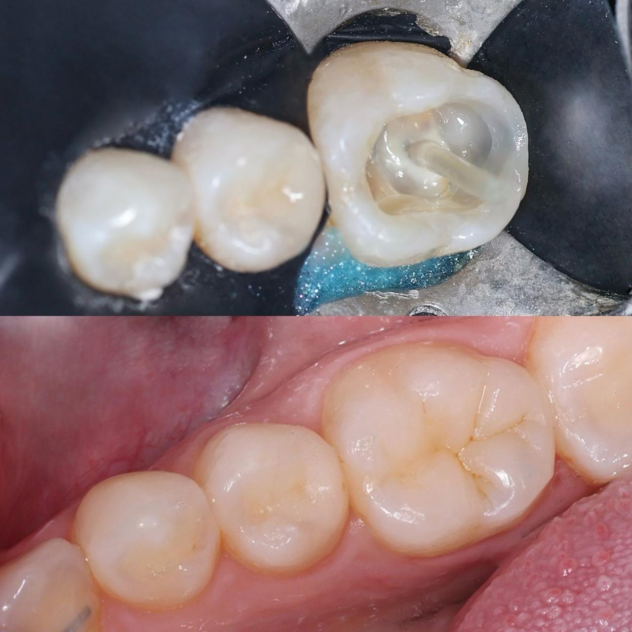 фото-пример лечения зубов под микроскопом 6
