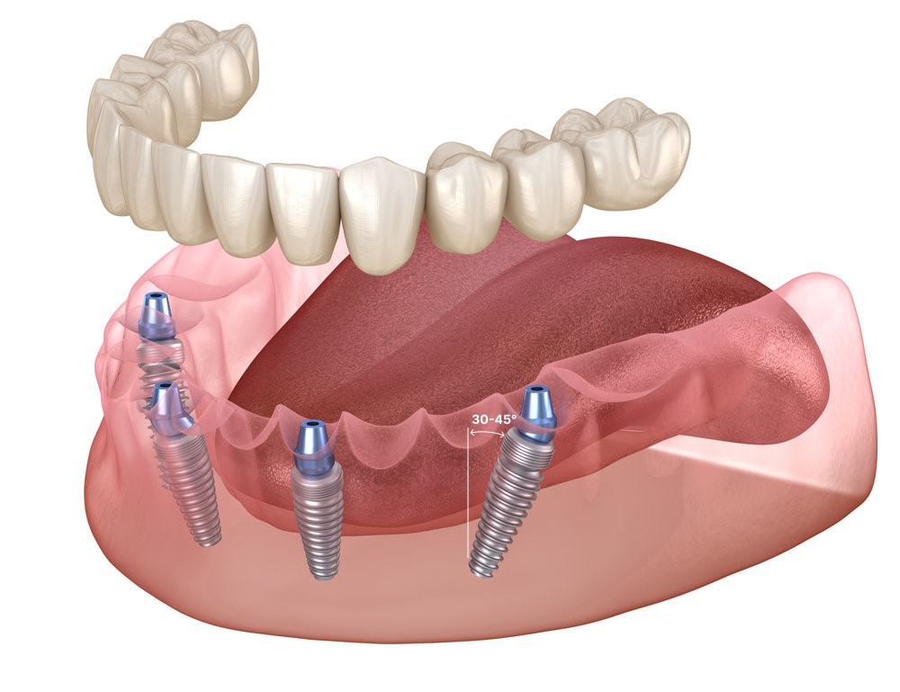 протезирование зубов all on 4