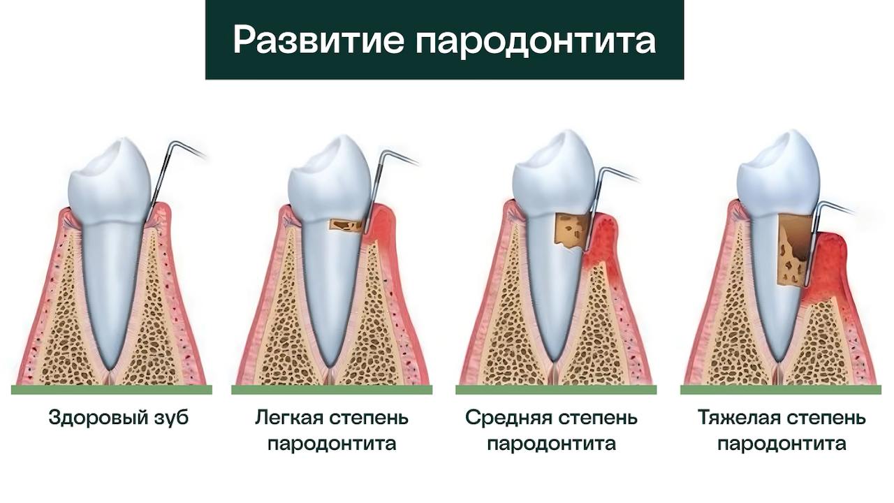 развитие парадонтита