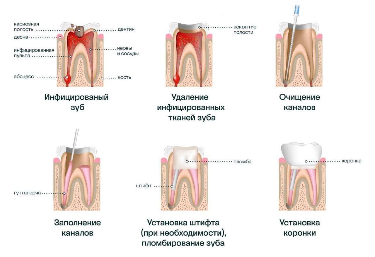 Реакция на пломбировочный материал