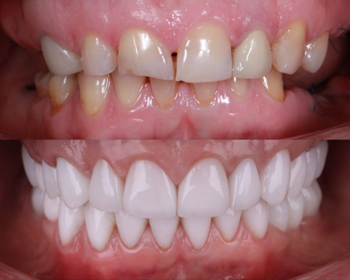 тотальное протезирование зубов