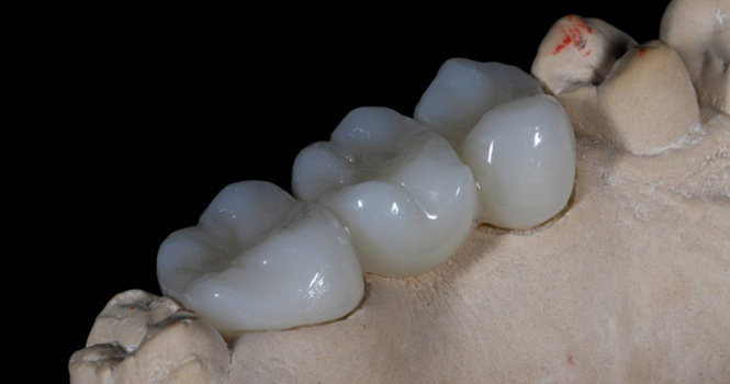 Циркониевые коронки с керамическим покрытием - 1