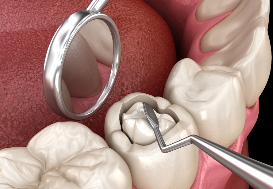 установка пломбы на зуб