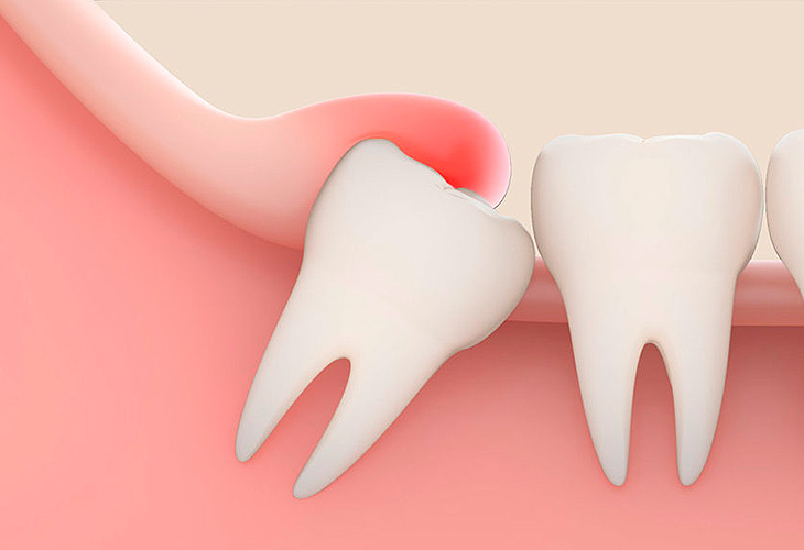 лезет зуб мудрости