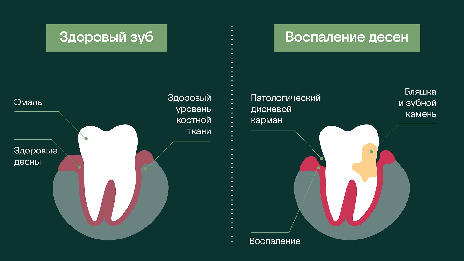 камень на зубах