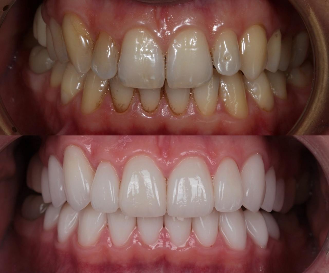 пример керамических виниров на зубах